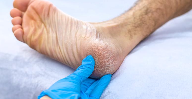 What's Causing Your Heel Pain?: Eric Blanson, DPM: Sports Medicine